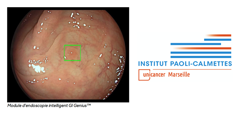 L'Institut Paoli-Calmettes met en service GeniusTM Medtronic, système d’intelligence artificielle pour détecter les polypes colorectaux
