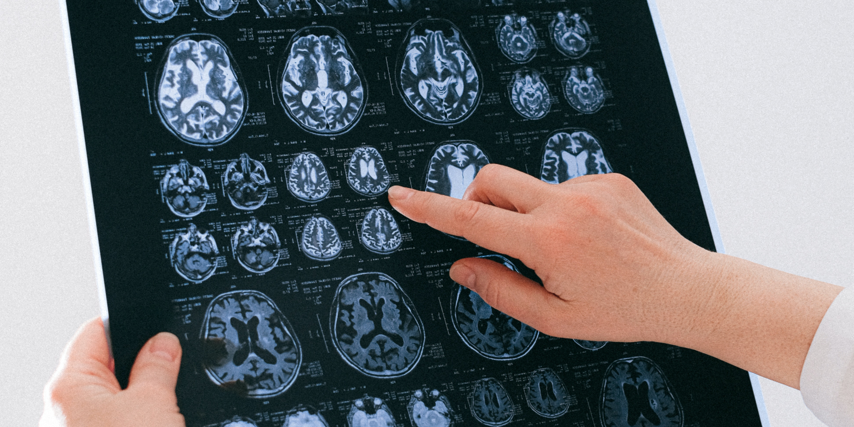 Restoring consciousness through deep thalamic stimulation