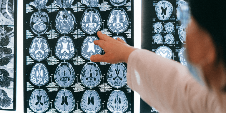 IA et génomique : la perte de l’homéostasie neuronale joue un rôle central dans la maladie de Huntington