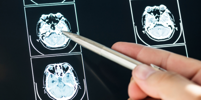 IA et oncologie : l’IUCT-Oncopole et l’IRT Saint Exupéry présentent les résultats de leurs premiers travaux pour lutter contre les tumeurs du cerveau